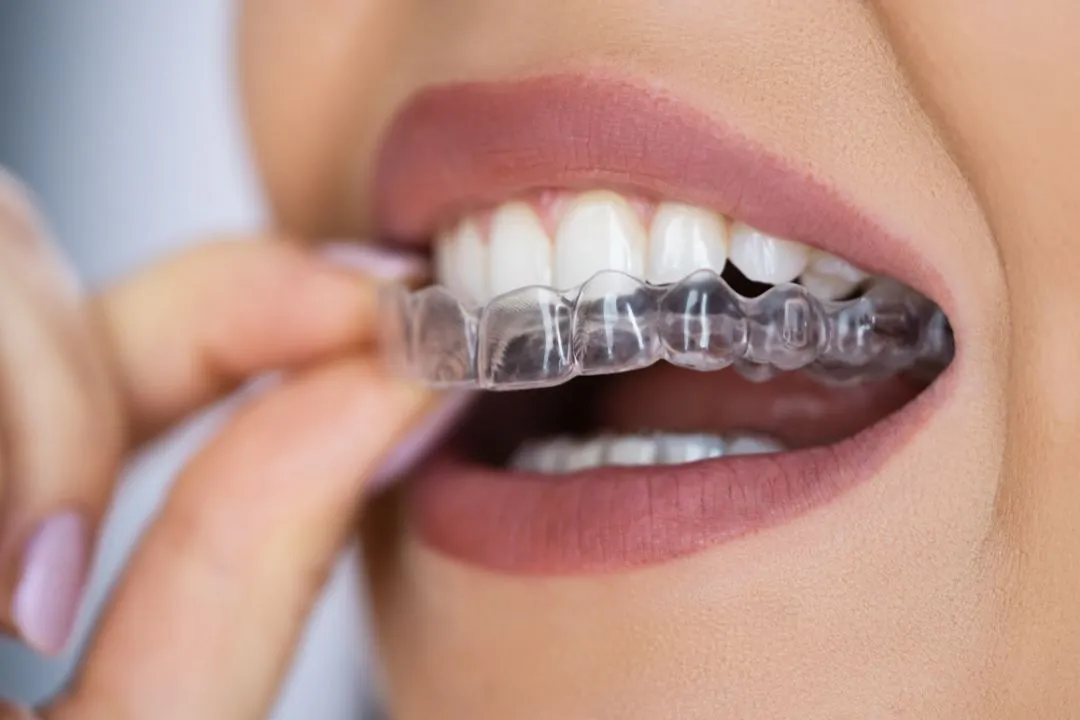 Person placing a clear dental aligner over the upper teeth